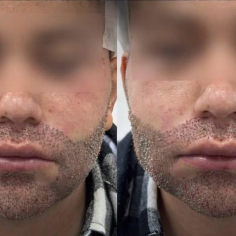 Transplante de Barba Fue